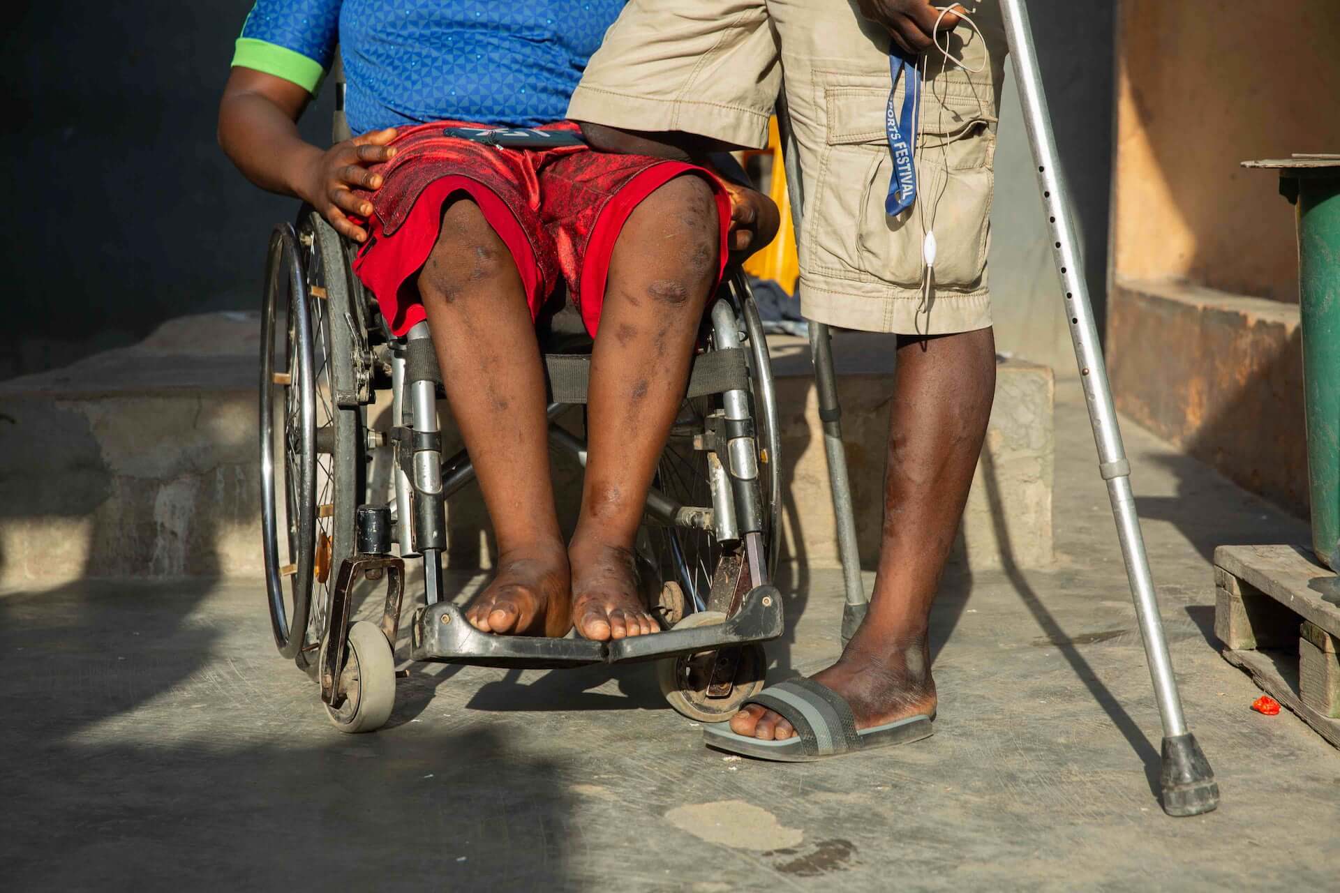 A photo of Olajumoke’s and Suraju’s legs. She sits in her wheelchair and he stands next to her, resting his amputated leg on her knee.